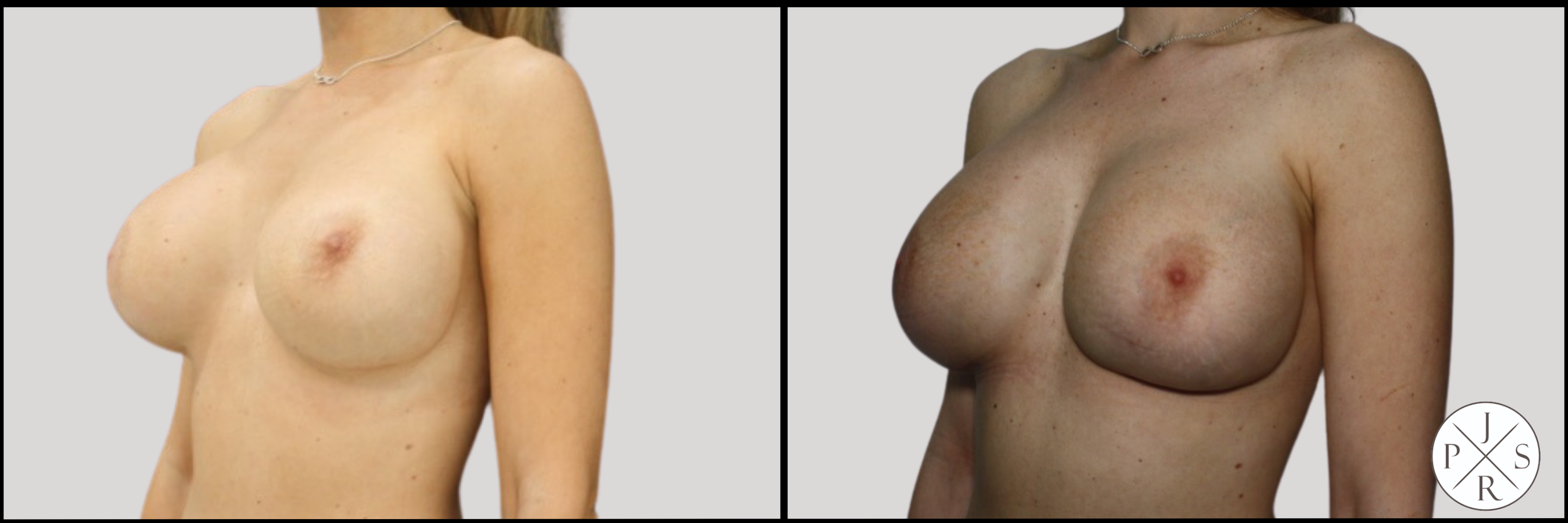 Breast Revision Before & After Image